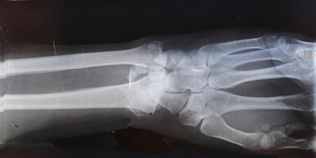 My Workers Comp Injury Got Worse. Now What?